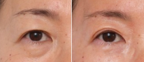 Asiatiske øvre øjenlåg - cases