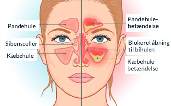 Illustration - Bihulebetændelse & bihuleproblemer - behandling på AROS