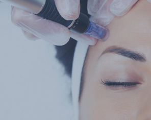 Microneedling