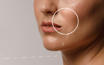 Filler varighed - over 12 mdr.