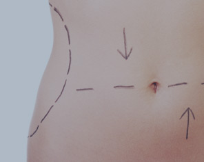 Kirgurisk kropsløft