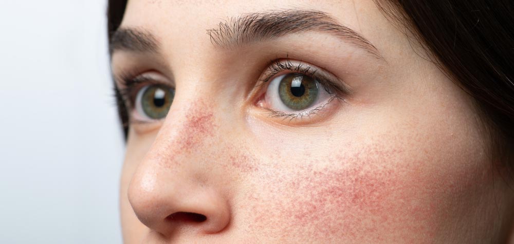 Ansigtsrødme og rosacea - behandlinger