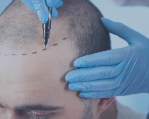 FUE Hårtransplantation - SMARTGRAFT