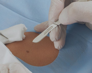 Ekscision/ operation