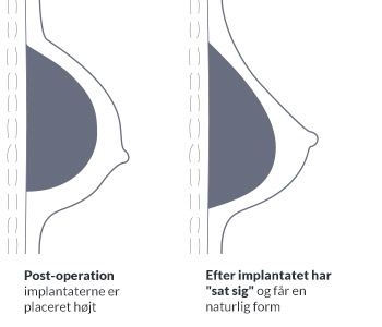 Post-operation - hvor implantaterne er placeret højt og Efter implantatet har 